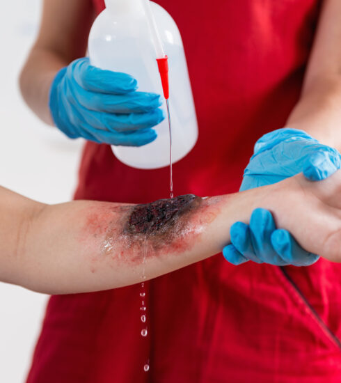 First Aid Training - Burn injury