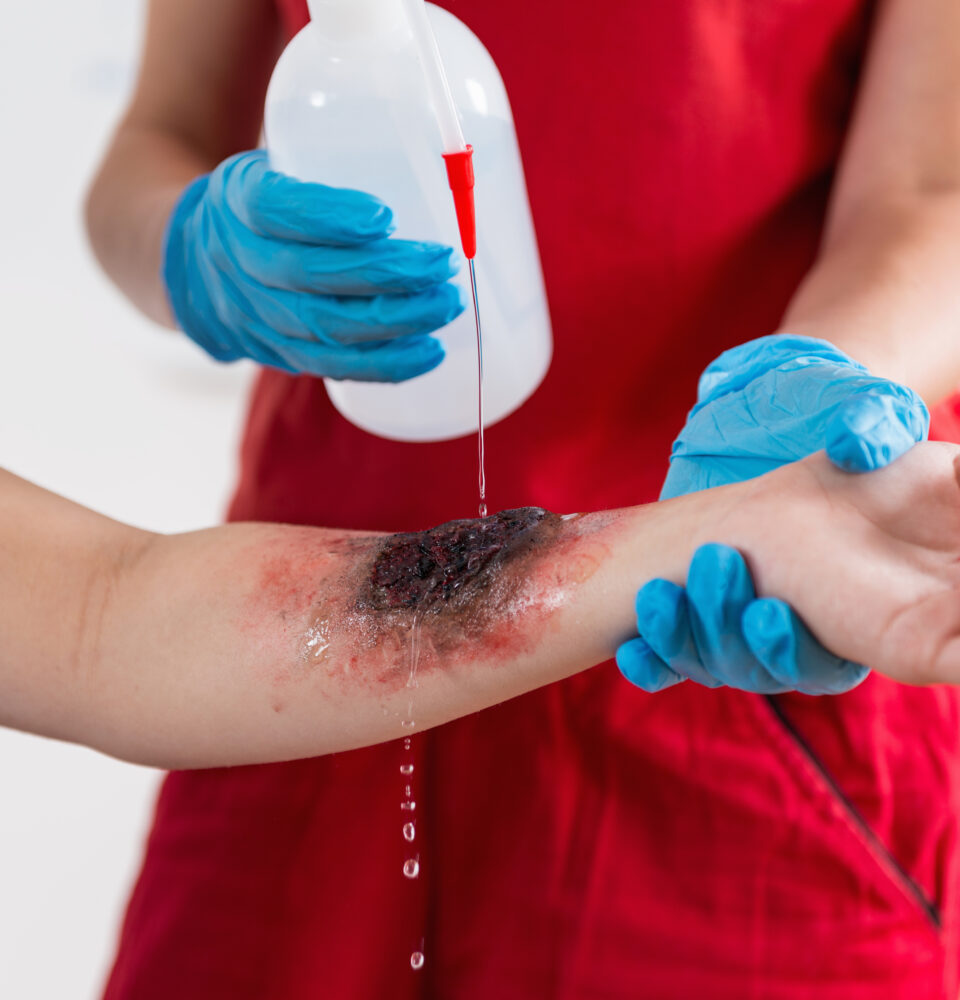 First Aid Training - Burn injury
