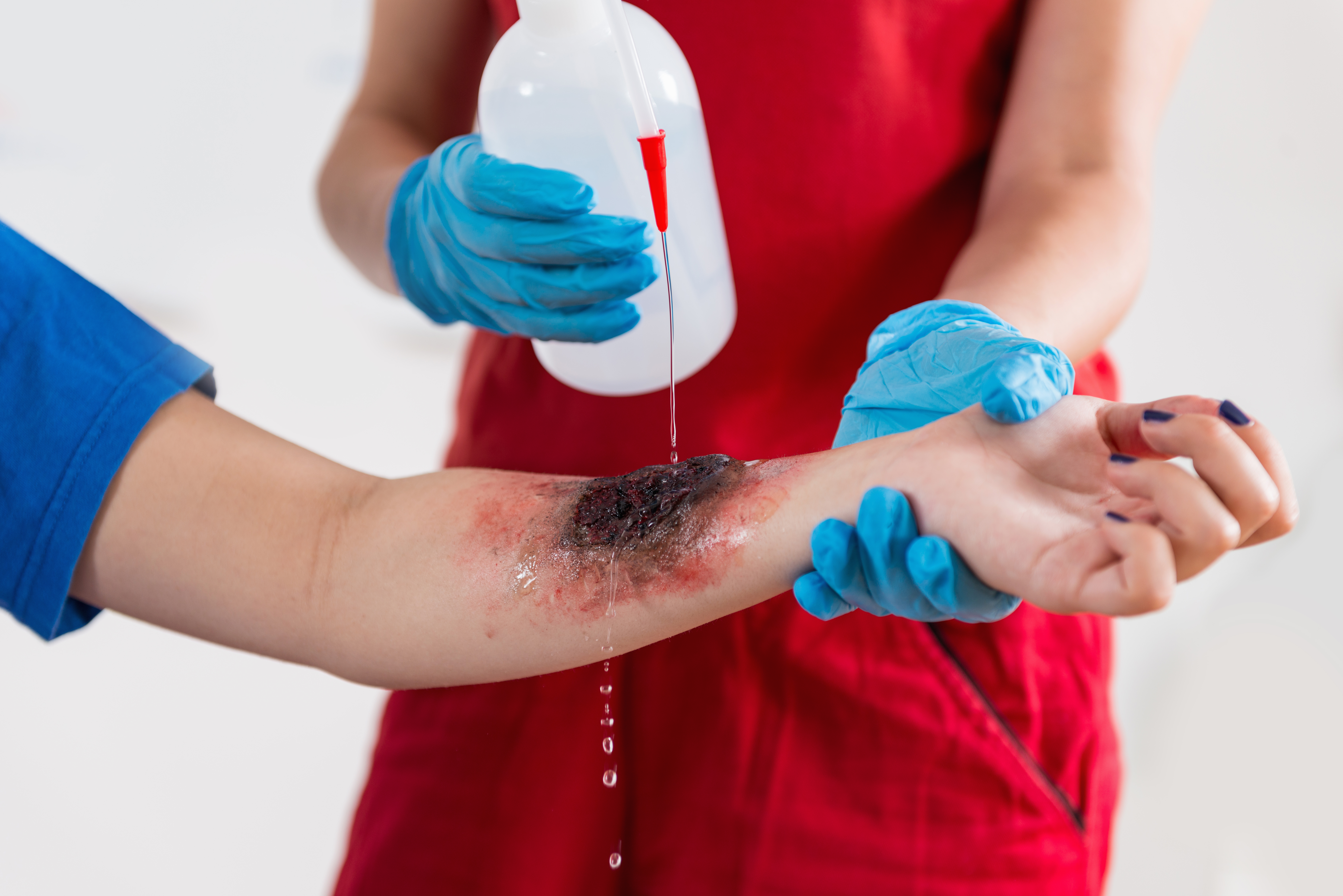 First Aid Training - Burn injury